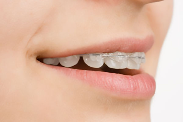 Clear Braces: Aligners & Teeth Straightening