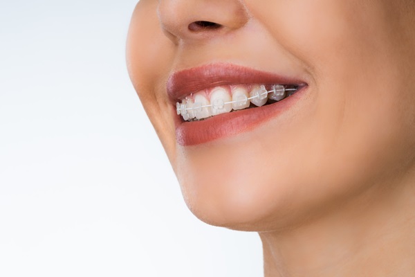 Adult Braces: Key Things To Know