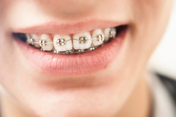 How Long Does it Take For Braces to Straighten Teeth?