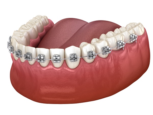 Be Vigilant With Dental Care While Wearing Braces - Henry Orthodontics  Pinehurst, North Carolina