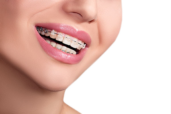 Braces vs. Clear Braces vs. Clear Aligners: Which treatment is right for  me?