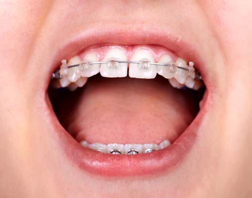 Learn About Phase-One Early Orthodontic Treatment - Henry Orthodontics  Pinehurst, North Carolina