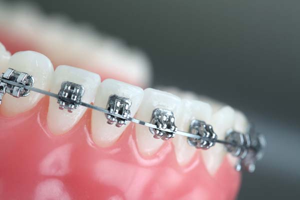 Transform Your Smile Today With Orthodontic Treatment