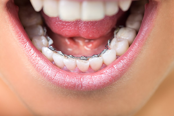 5 Benefits of Teeth Straightening - Henry Orthodontics Pinehurst